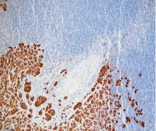 CK (Pan-Cytokeratin) Breast Cancer Metastatic Lymph Node Staining Results