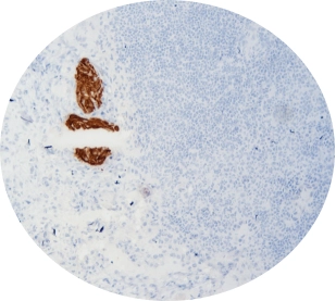 CK19 Thyroid Lymph Node Staining Results