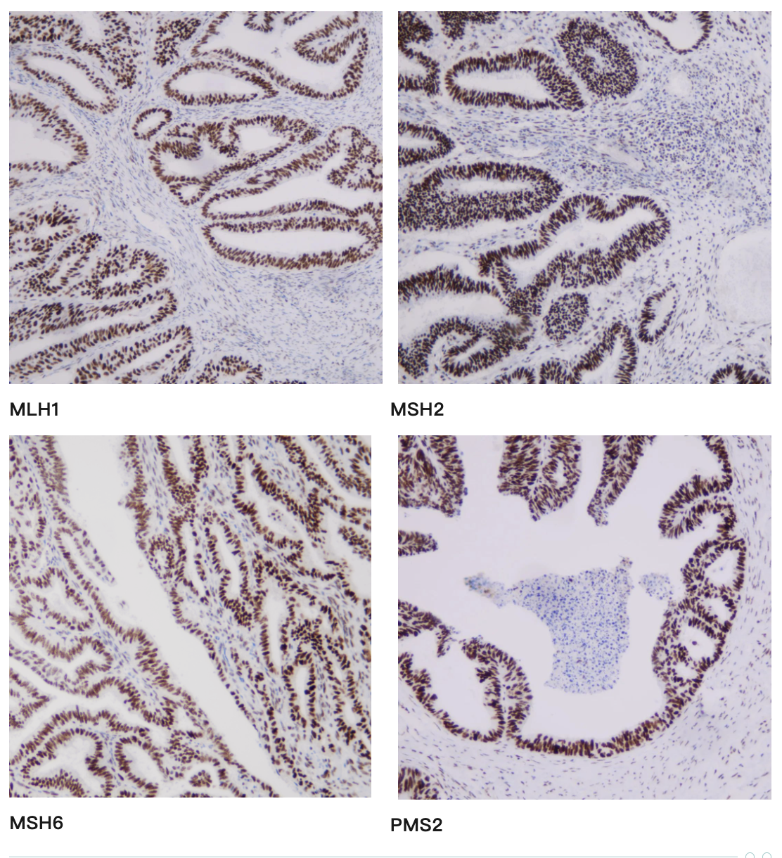 MMR Staining Example