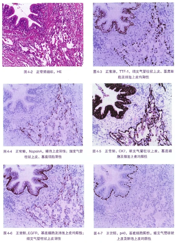 Understanding Lung Tumor Markers A Guide to Immunohistochemistry for Pathological Diagnosis