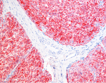 Exploring the Benefits of Multiplex Immunohistochemistry Over Conventional IHC