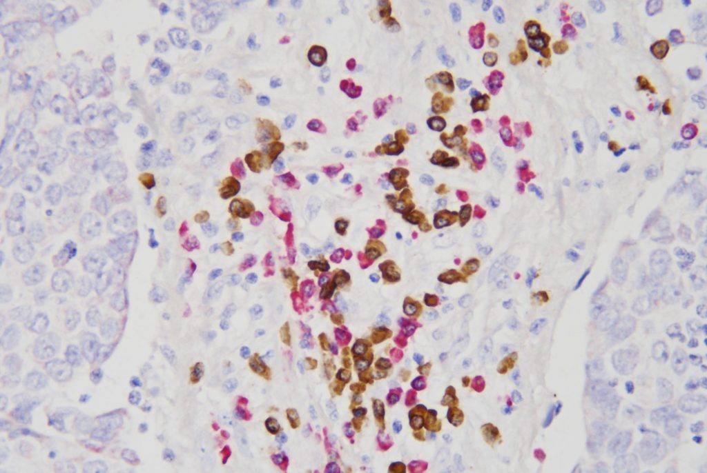 Lymphoma KappaLambda Probe Double Staining