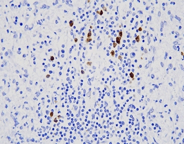 The Kappa Lambda ISH Probe for Lymphoma Diagnostics