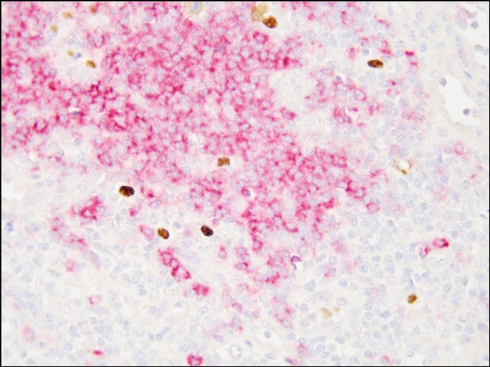 Lymphoma EBER+CD20 Dual Staining Kit