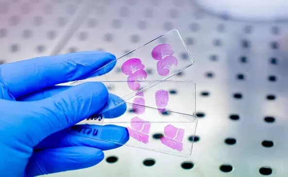 Why the IHC Single Marker Test Matters in Diagnosis