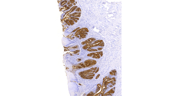 CA125(OC125),MMab