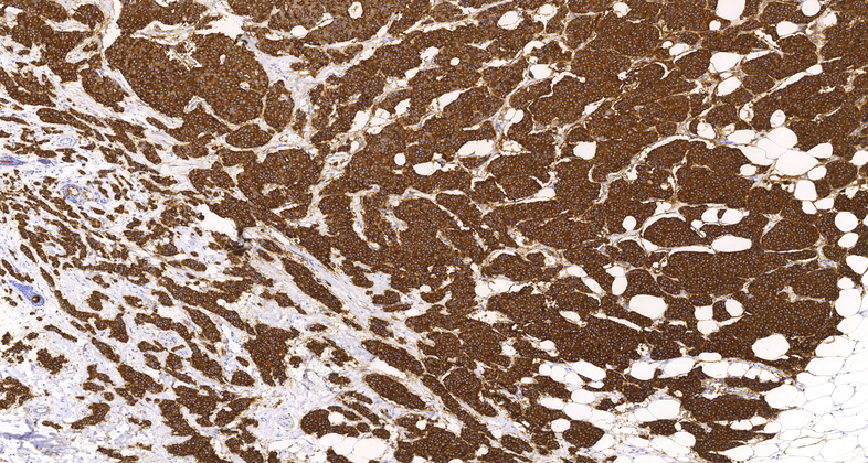 CA15-3(DF3),MMab