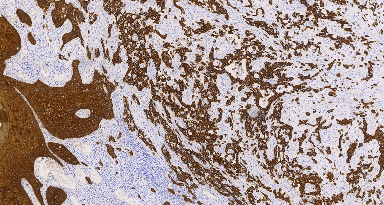 Cytokeratin 5&6 (C6H1/C1C8), MMab