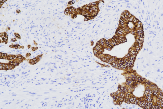 Cytokeratin Cocktail (C7C4/C5D12),MMab