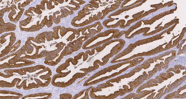 Cytokeratin (CAM5.2),MMab