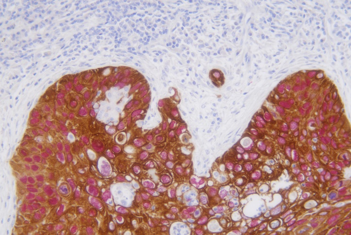 CK5/6/TTF-1 detection reagent (Immunohistochemical)