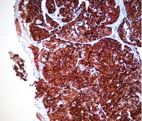 Immune Chromogenic Reagent (Dual Staining II)