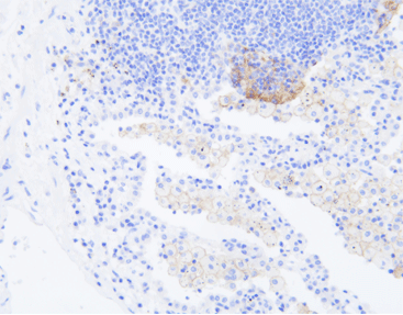 PD-L1: An important biomarker for companion diagnostics