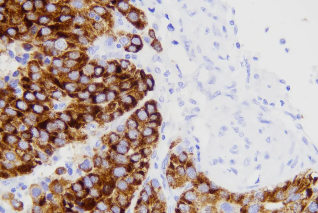 Super-ISH™：Albumin mRNA in-situ Hybridization Assists in the Diagnosis of Hepatocellular Carcinoma