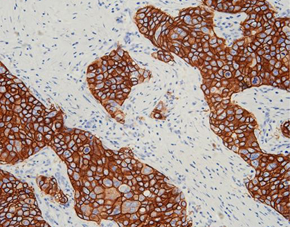 How HER2 Testing Can Help in Early Cancer Detection