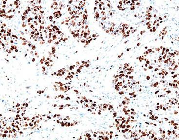 What Causes Primary Antibody Deficiency? Symptoms and Treatment Guide