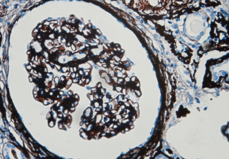 Periodic Acid‑Silver Methenamine Stain