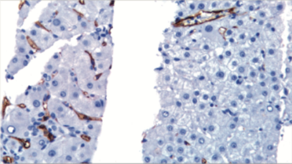 CD34 immunohistochemical staining in hemangioma