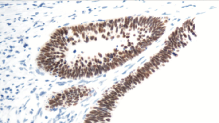 CDX2 immunohistochemical staining in rectal adenocarcinoma