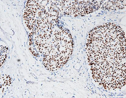 Progesterone Receptor