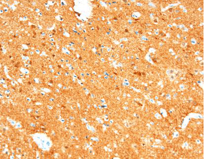 Neuron Specific Enolase (NSE)