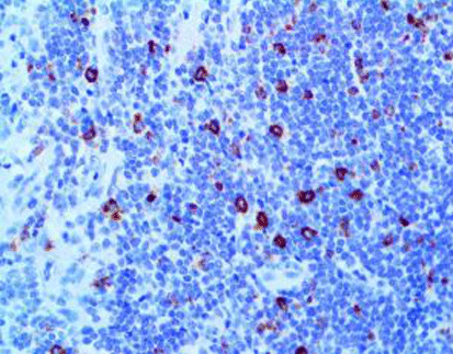 Alpha-1-Antitrypsin(AAT)