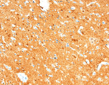 Neuron Specific Enolase (NSE)