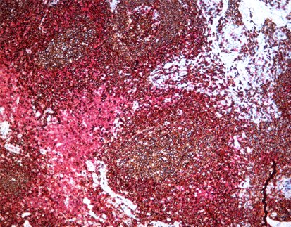 Immune Chromogenic Reagent (Dual Staining I)