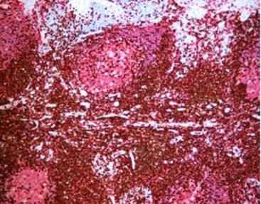 Immune Chromogenic Reagent (Dual Staining II)