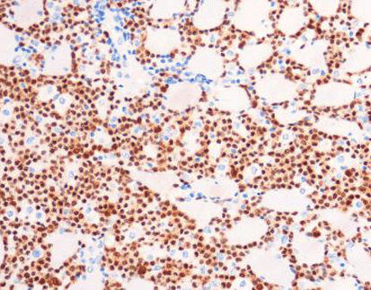 Anaplastic Lymphoma Kinase(ALK) (CD246)(p80)