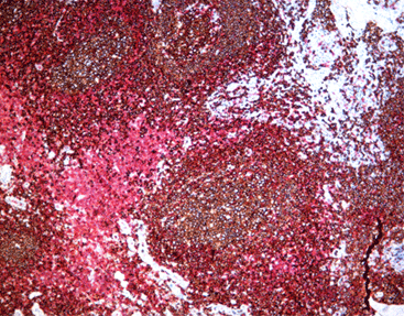 Immune Chromogenic Reagent (Dual Staining I)