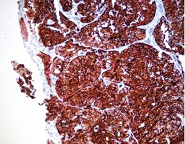 Immune Chromogenic Reagent (Dual Staining II)