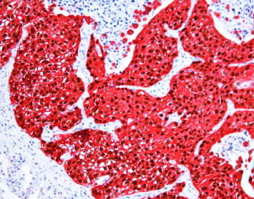 Immune Chromogenic Reagent (Dual Staining I)