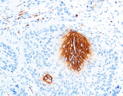 Carcinoembryonic Antigen(CEA)