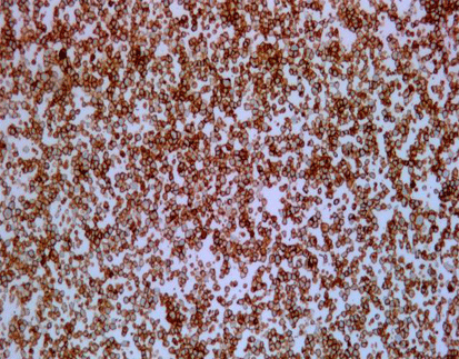 C-erB-2 Oncoprotein (HER-2)