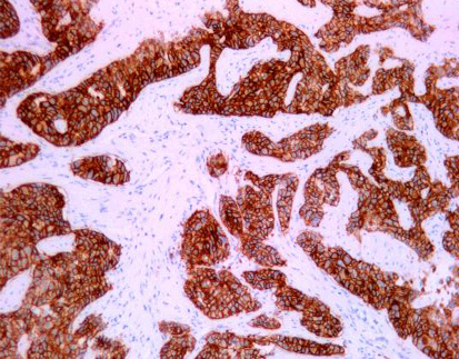 C-erB-2 Oncoprotein (HER-2)