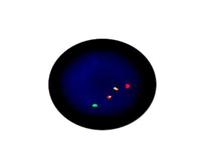 AML/ETO Gene Fusion Detection Kit