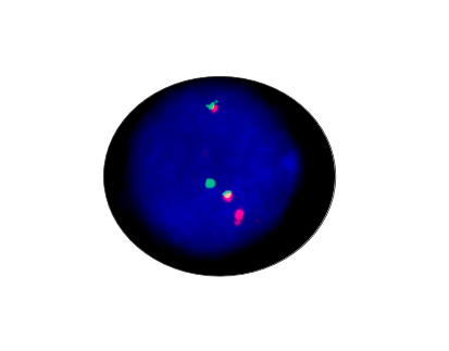 CBFB/MYH11 Gene Fusion Detection Kit