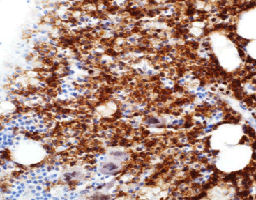 CD25(Interleukin-2 Recepter)