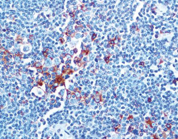 CD25(Interleukin-2 Recepter)