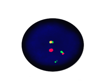 C-MYC/IGH Fusion Gene Detection Kit