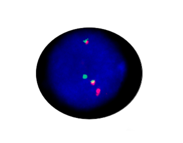 CBFB/MYH11 Gene Fusion Detection Kit