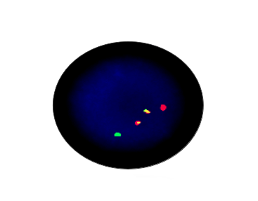 AML/ETO Gene Fusion Detection Kit
