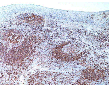 CD45R(B CELLS)