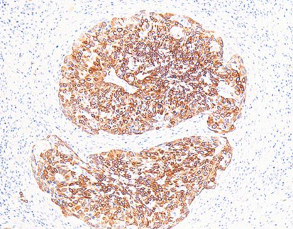 Cytokeratin 5/6 CK5/6