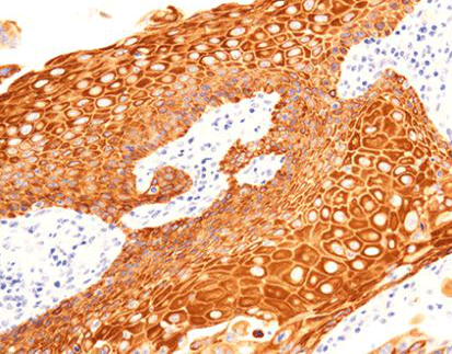 Cytokeratin 5/6 CK5/6