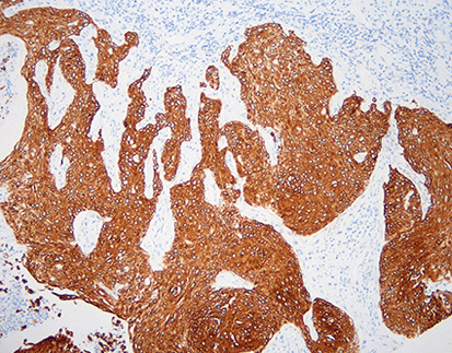 Cytokeratin 6 CK6