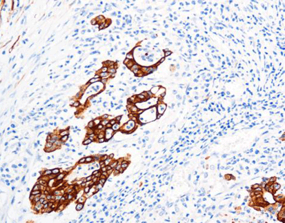 Cytokeratin 19 CK19