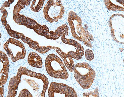 Cytokeratin(CAM5.2)