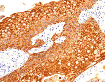 Cytokeratin 5/6 CK5/6